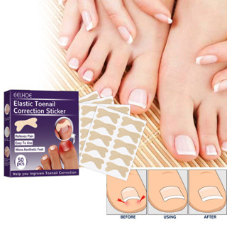 EELHOE elastic toenail correction patch, nail repair ingrown