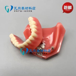 小百合模種植修復模型 下頜種植體活動義齒修復醫患溝通種植解說 包郵模型展示模型