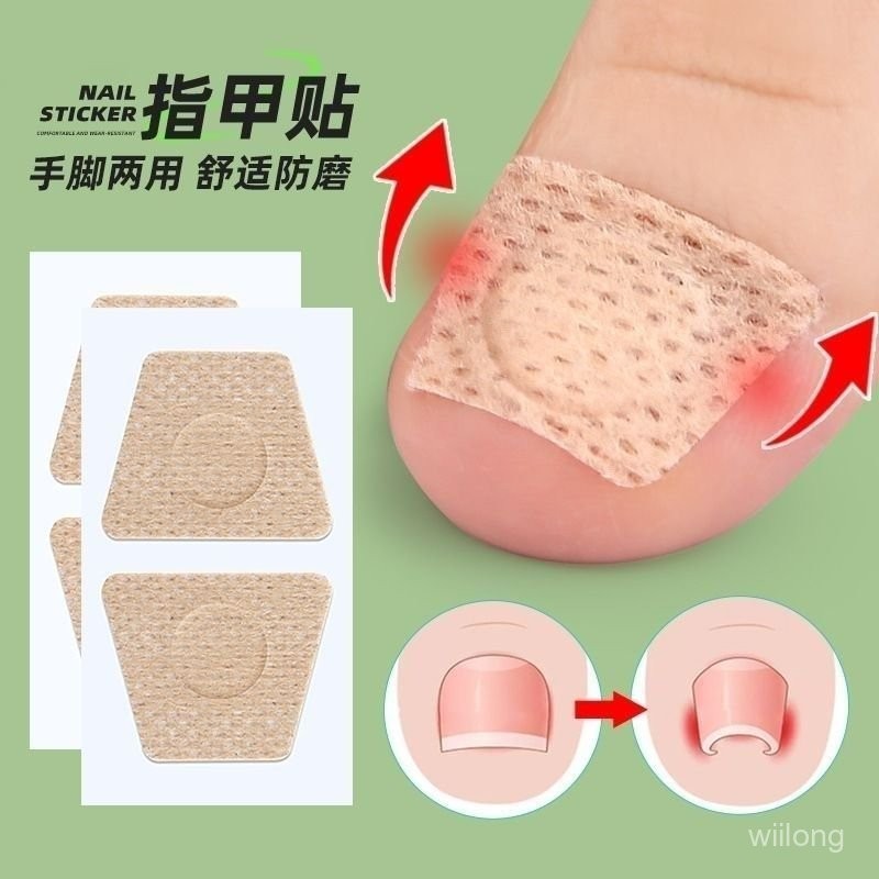 指甲護理貼片嵌甲甲溝往肉裏長腳趾墊矯形貼軟甲灰指甲修護貼 XF5H