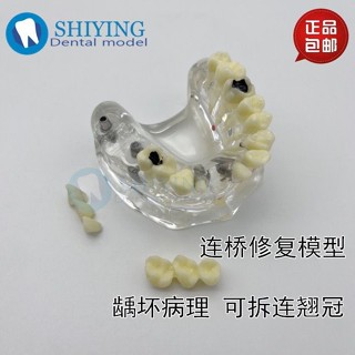 小百合模種植修復對比模型 半口連橋修復模型 全口義齒連橋冠病理2006模型展示模型
