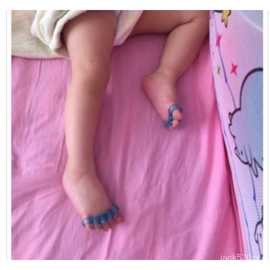 【拼全臺灣最低價格】嬰兒幼兒童寶寶腳趾矯正器 腳趾重疊彎曲防磨 腳部拇指外翻分趾器