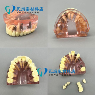 小百合模模型 種植冠橋修復體模型 可拆卸上半口種植釘解剖結構 包郵模型展示模型