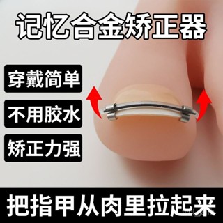 🔥熱賣ᴴᴼᵀ🔥甲溝炎矯正神器嵌甲矯正器指甲內扣矯正器糾正器腳趾扣炎正甲貼