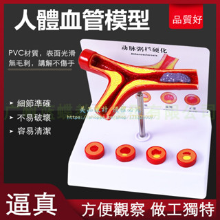 人體支脈硬化粥樣模型 形成血栓模型 血管模型血液科硬化動脈模型【美品LDYX】