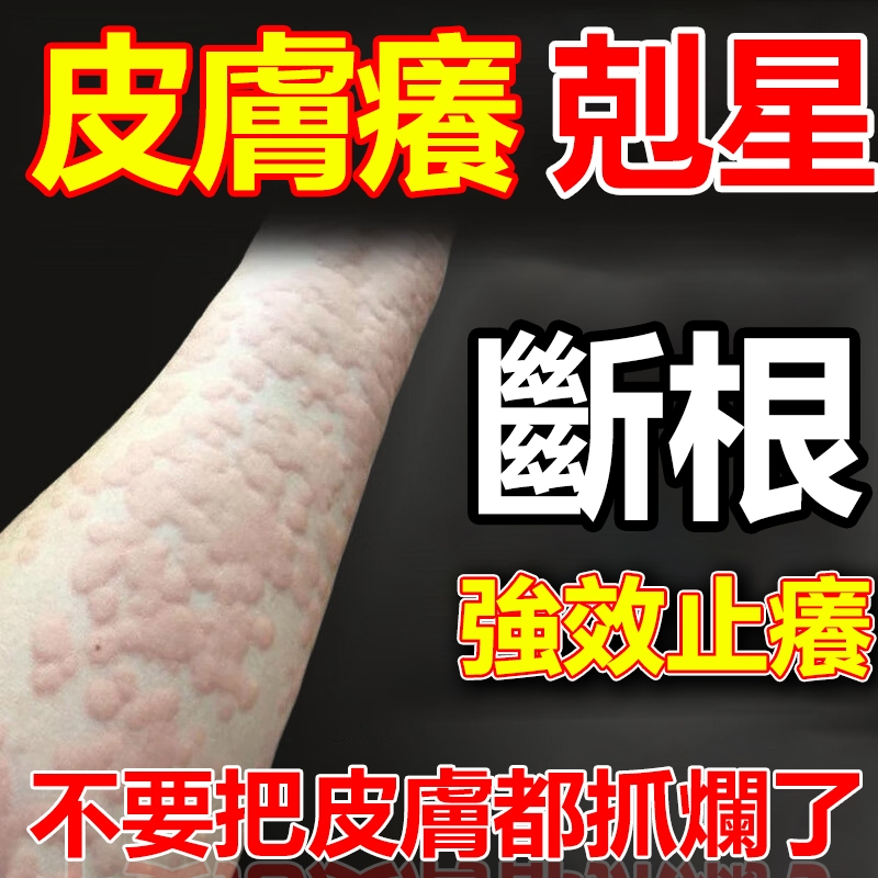 【草本止癢軟膏】止癢肓 荨麻疹 汗皰疹 濕疹 皮炎 手癢 腳癢 止癢 過敏 外用乳育