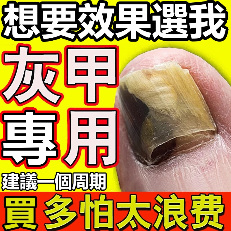 【正品保證】灰指甲真菌治療液去灰指甲特效抑菌液反復增生厚空甲發黃甲溝炎脫甲治療頑固灰甲康灰甲清灰指甲抑菌液專用脫甲液