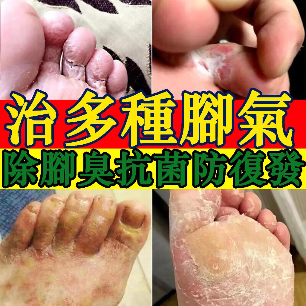 【呵護足部】香港腳噴霧汗腳脫皮腳水泡除臭噴霧足蘚真菌感染濕疹腳氣止癢膏腳底汗皰疹足爽爛腳止癢噴霧臭粉腳抑菌腳氣王噴劑