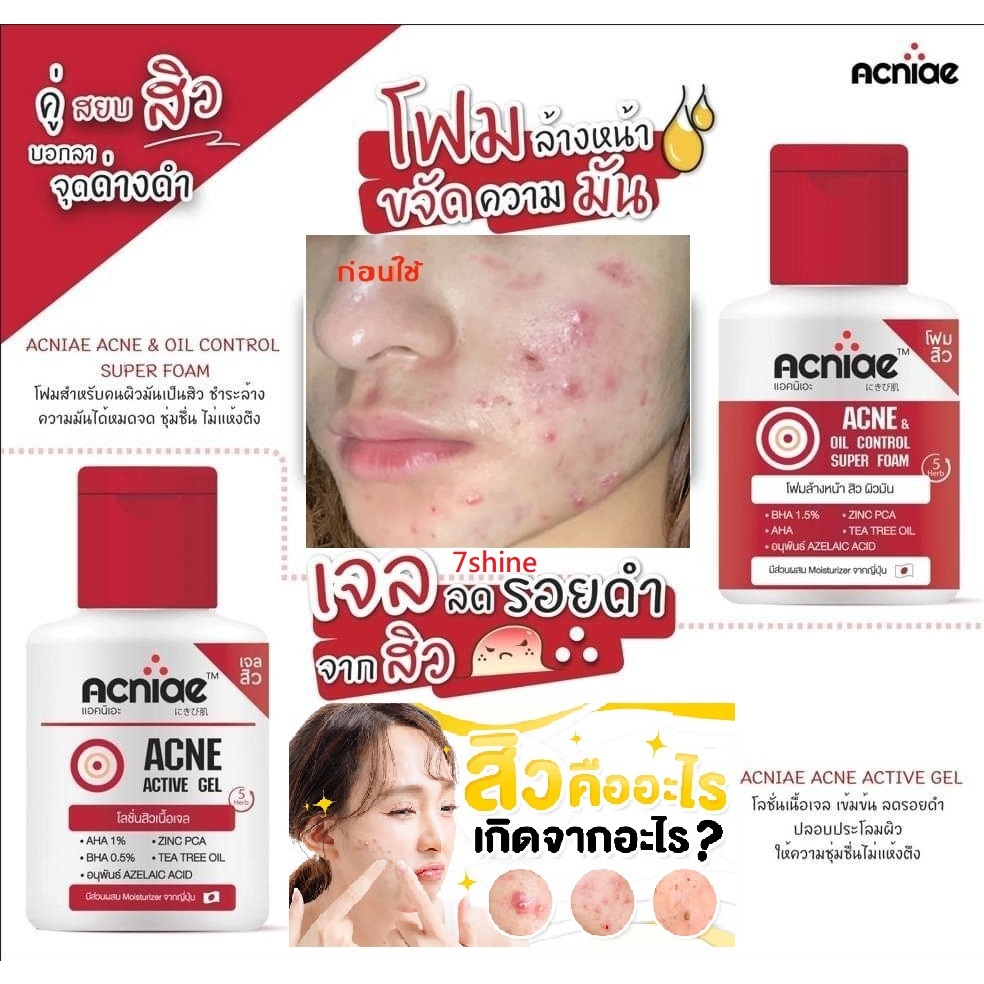 正版公司貨中文標已登錄 Acne &amp; Oil Control Foam Acne Gel 60g 痘痘洗面乳 痘痘凝膠