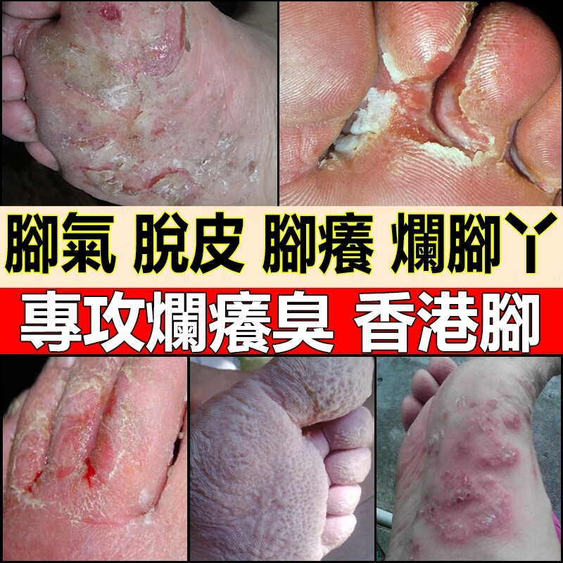 【腳臭脱皮】香港腳氣噴劑足爽腳臭治療腳癢腳脫皮除腳氣抑菌治療香港腳剋星爛腳丫腳氣噴霧腳除臭腳氣抗真菌治療水泡足癬腳氣噴劑