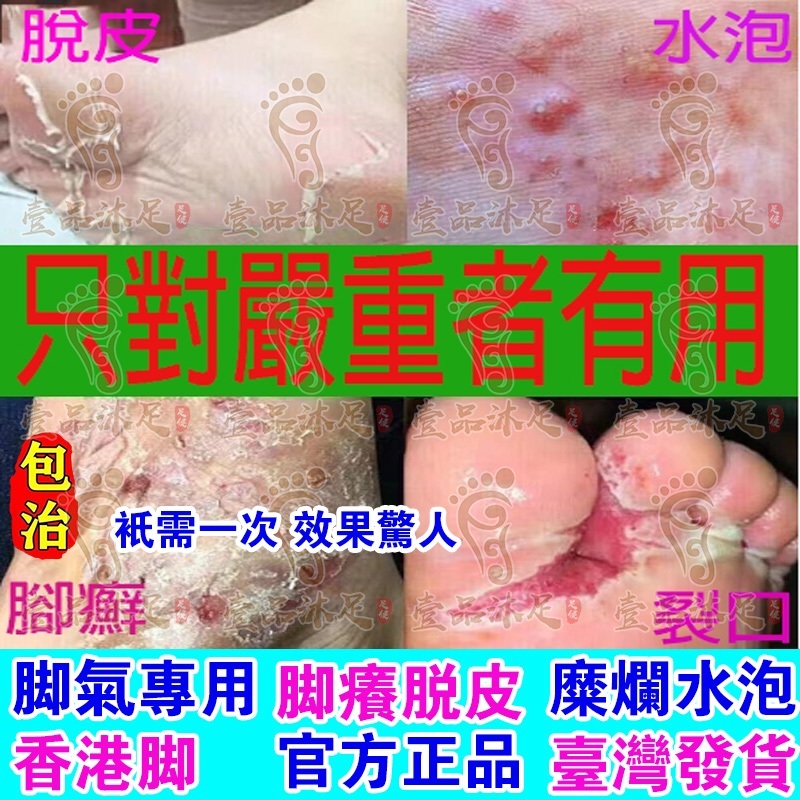 【壹品沐足】一周見效💥腳氣噴劑殺菌止癢去腳氣香港腳噴劑治爛腳丫糜爛腳腳氣水去腳汗腳底發白瘙癢足爽腳臭粉去水泡水疹脫皮腳氣