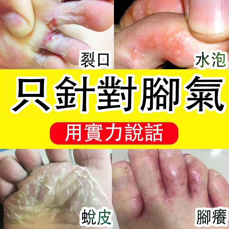 💥腳氣困擾💥腳氣噴劑殺菌止癢去腳氣香港腳噴劑治爛腳丫糜爛腳腳氣水去腳汗腳底發白瘙癢足爽腳臭粉去水泡水疹脫皮腳氣真菌感染