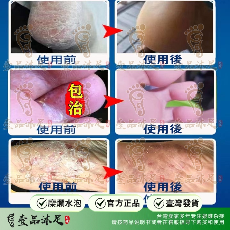 【壹品沐足】一周見效💥腳氣噴劑殺菌止癢去腳氣香港腳噴劑治爛腳丫糜爛腳腳氣水去腳汗腳底發白瘙癢足爽腳臭粉去水泡水疹脫皮腳氣