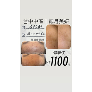 清粉刺/液態皮秒/去角質/淡化黑色素/水飛梭/杏仁酸
