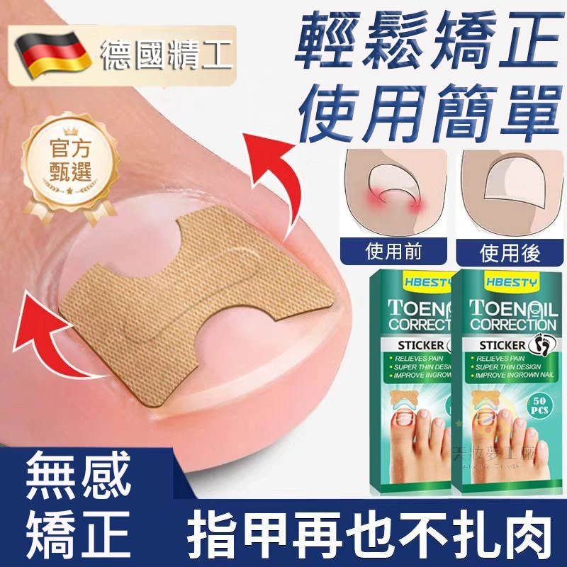 現貨🚚德國修凍甲正甲貼片 修甲溝炎 改正器正甲貼片 修指甲剪刀 凍甲刀 指甲長肉裏腳拉拉貼 腳趾甲貼片美甲工具 指甲美甲